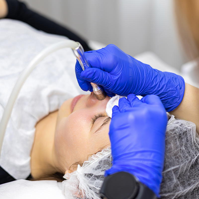 Microdermabrasion